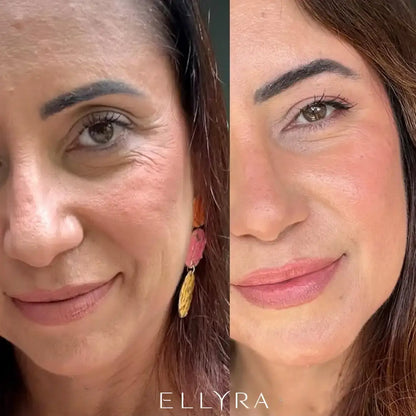 ELLYRA Dermalift™